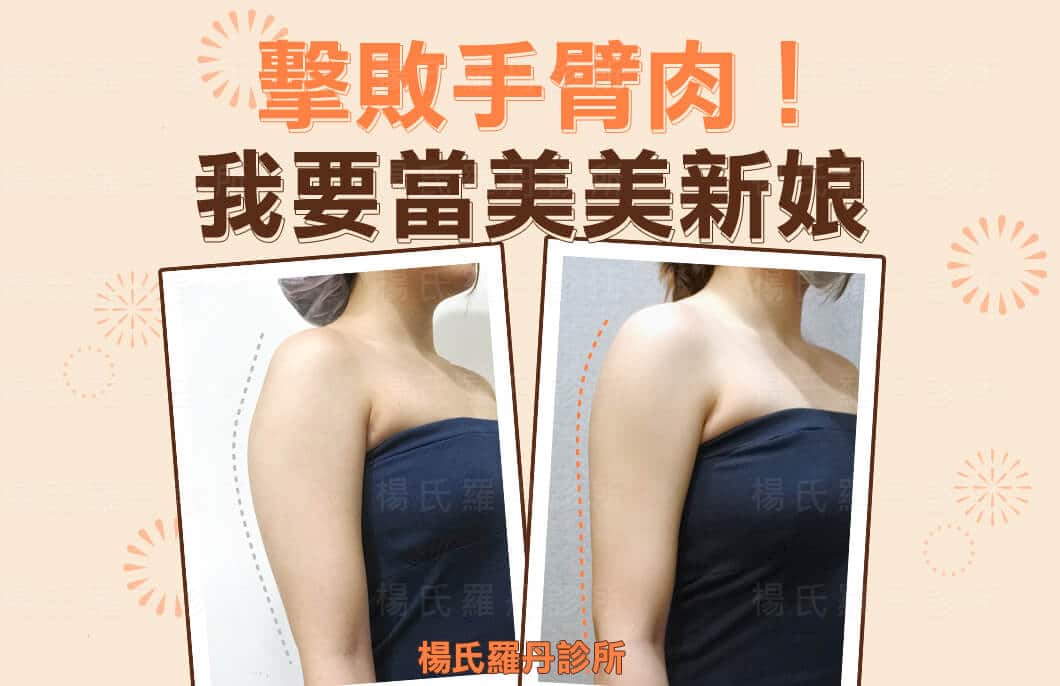 【雷射減脂】擊敗手臂肉！我要當美美新娘
